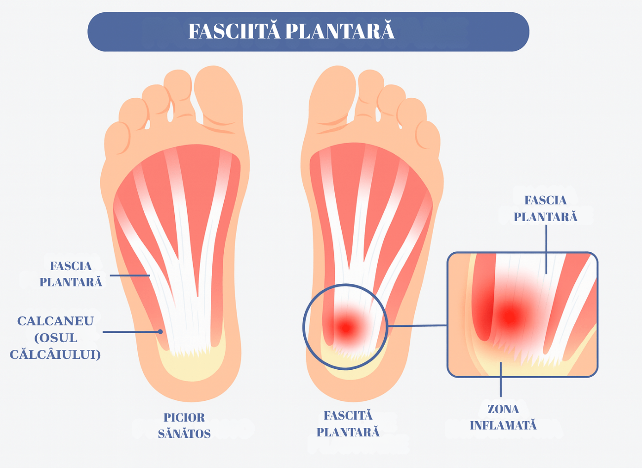 Natural Feet- Gel siliconic terapeutic